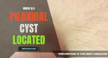 Pilonidal Cyst Icd 10