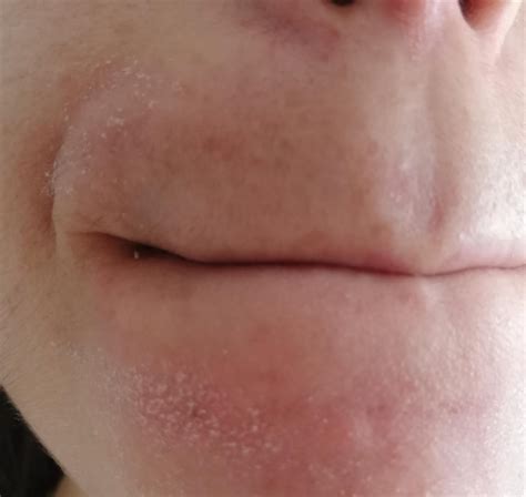pimecrolimus perioral dermatitis