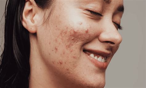 pimple