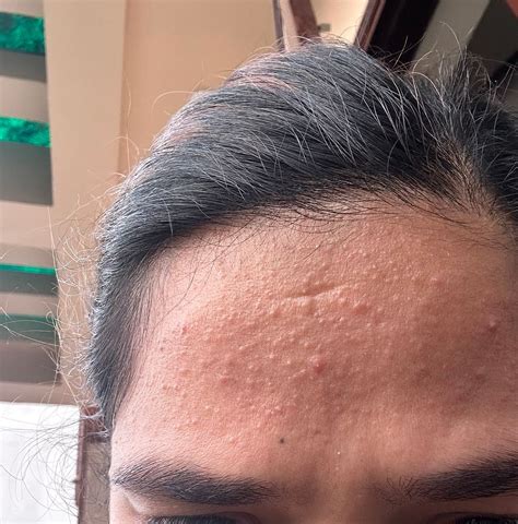pimples in first trimester