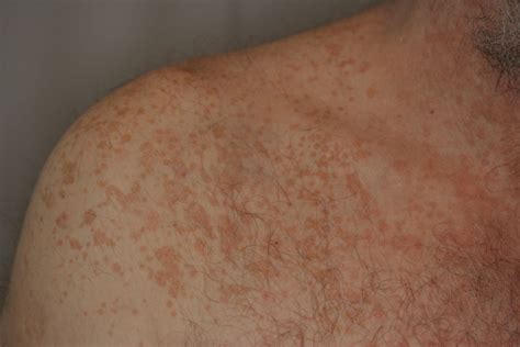 pitiriasis versicolor