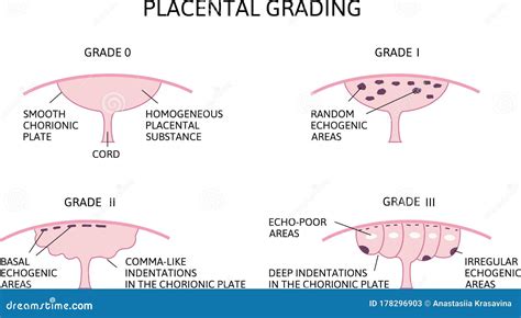 Placenta Grau 3