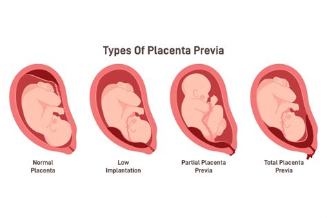 Placenta Previa Acog