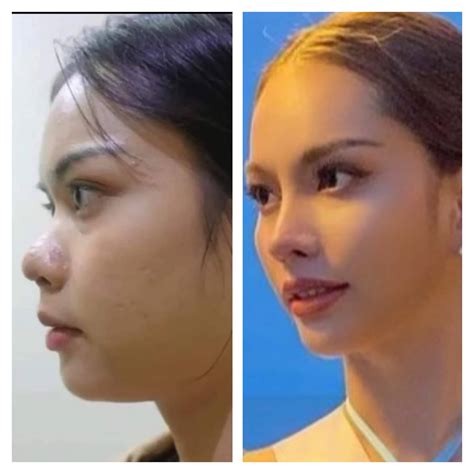 plastic surgery in thailand before and after - mouseferatu.com