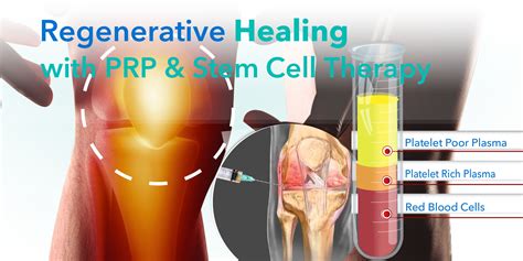 Full Download Platelet Rich Plasma Regenerative Medicine Sports Medicine Orthopedic And Recovery Of Musculoskeletal Injuries Lecture Notes In Bioengineering 
