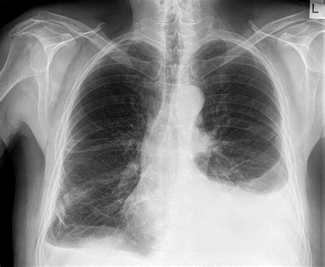 Pleural Effusion Cxr