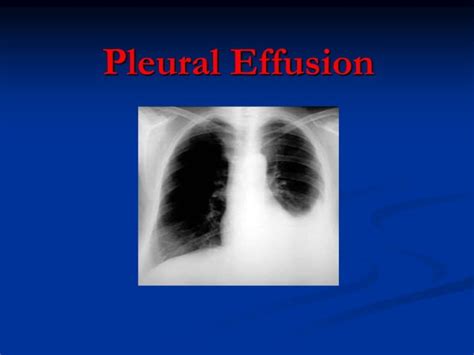 Pleural Effusion Ppt