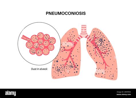 pneumoconiose