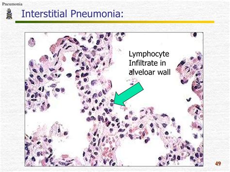 Pneumonia Pathology Ppt
