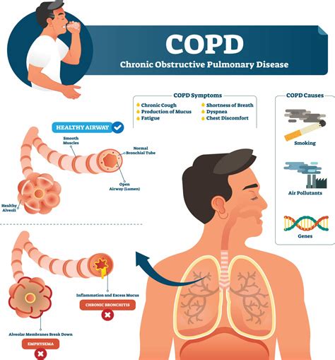 Pneumonia W Mild Copd
