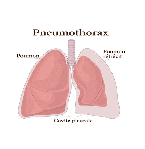 pneumothorax
