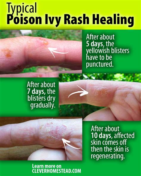 Poison Ivy Rash Healing Time