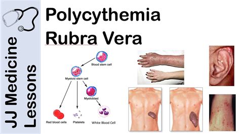 Policitemia Rubra Vera