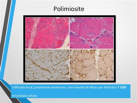 polimiosite e invalidità