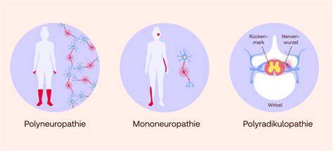polyneuropathien