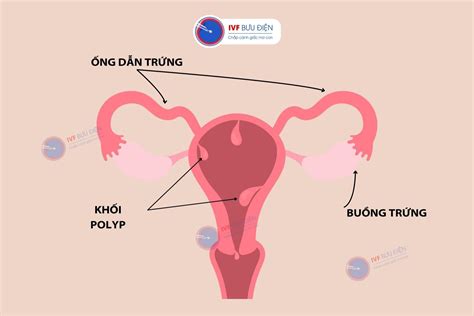 polyp tử cung | Polyp t cung c nguy him khng