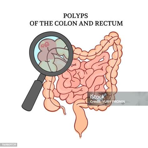 polyper i tarmen orsak