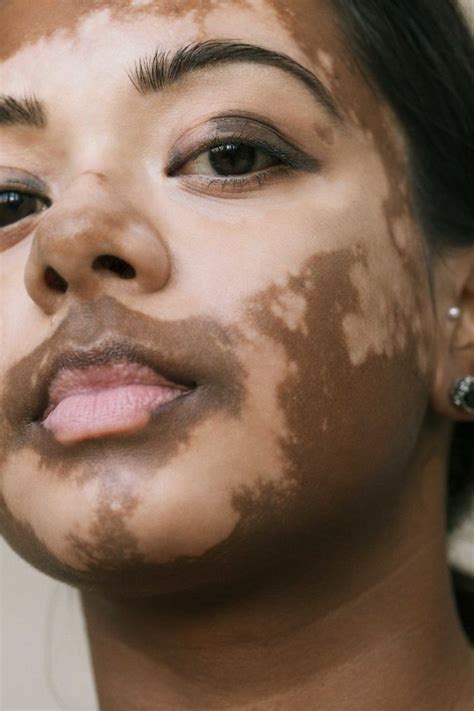 porn vitiligo