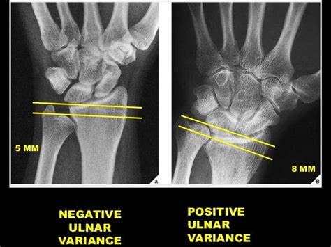 Positive Ulnar Variance