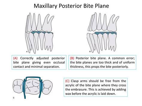 Posterior Bite Plane