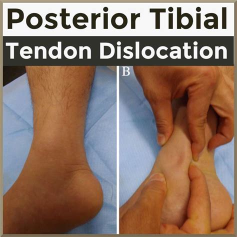 Posterior Tibialis Dislocation
