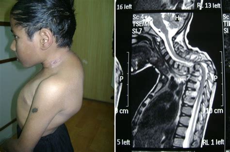 Pott's Disease Tuberculosis