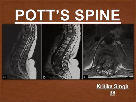Pott's Spine Ppt