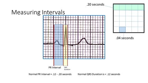 Pr Interval Measurement