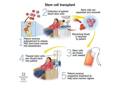 practical hematopoietic stem cell transplantation
