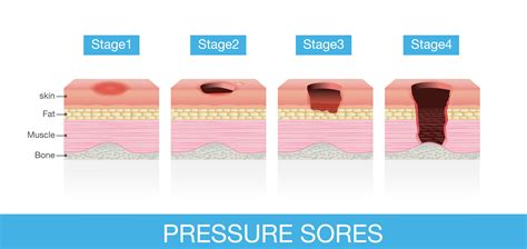 Pressure Sore Grading