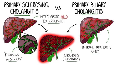 primary biliary cirrhosis