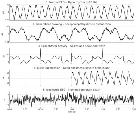 Primer Of Eeg With A Mini Atlas