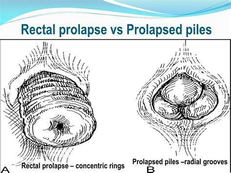 prolabs anus