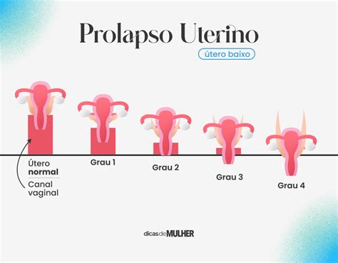 prolapso uterino