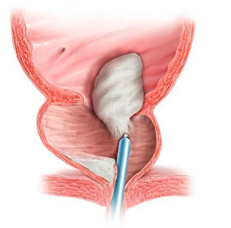 prostaatvergroting behandelingen