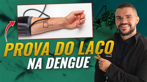 Prova Laço Dengue