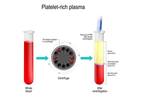 prp injection