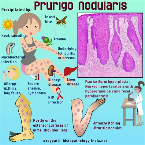 Prurigo Nodularis Hyde