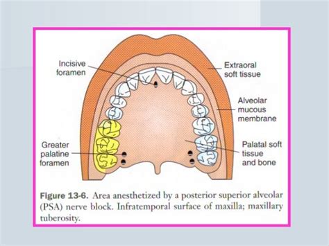 Psa Nerve Block