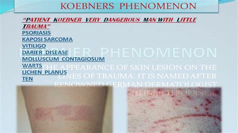 Pseudo Koebner Phenomenon