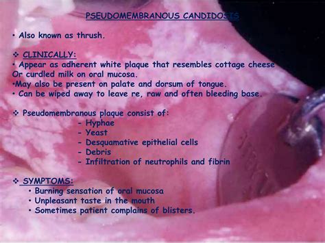pseudomembranous candidiasis symptoms