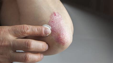psoriasis hudcancer