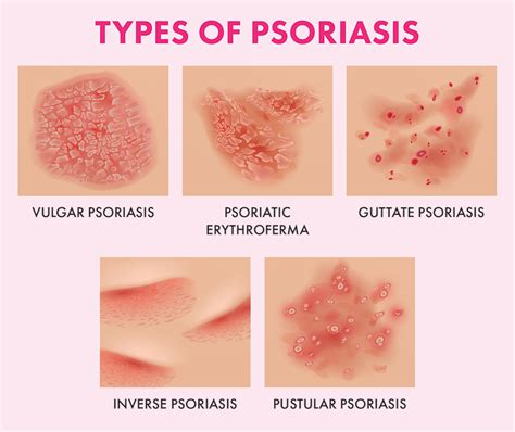psoriasis långt hår