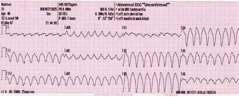 Psvt Icd 10