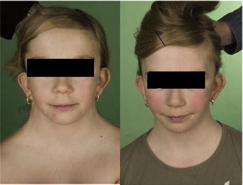 Pterygium Colli Deformity