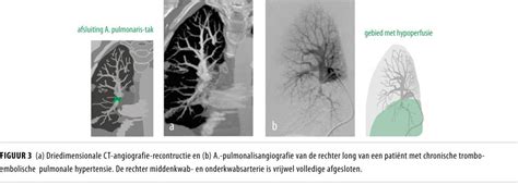 pulmonale aandoeningen