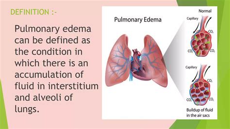 Pulmonary Edema Ppt