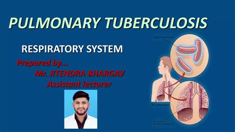 Pulmonary Tuberculosis Ppt