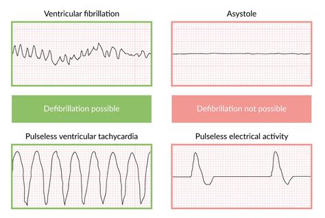 Pulseless Electrical Activity