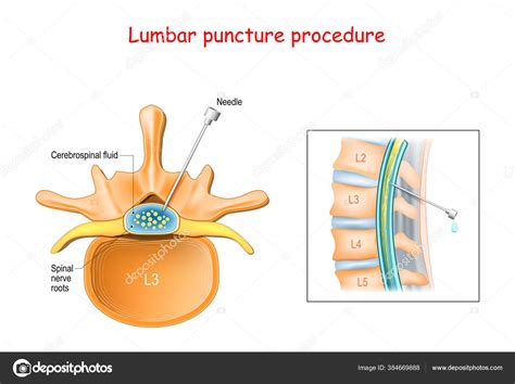 punctieprocedure